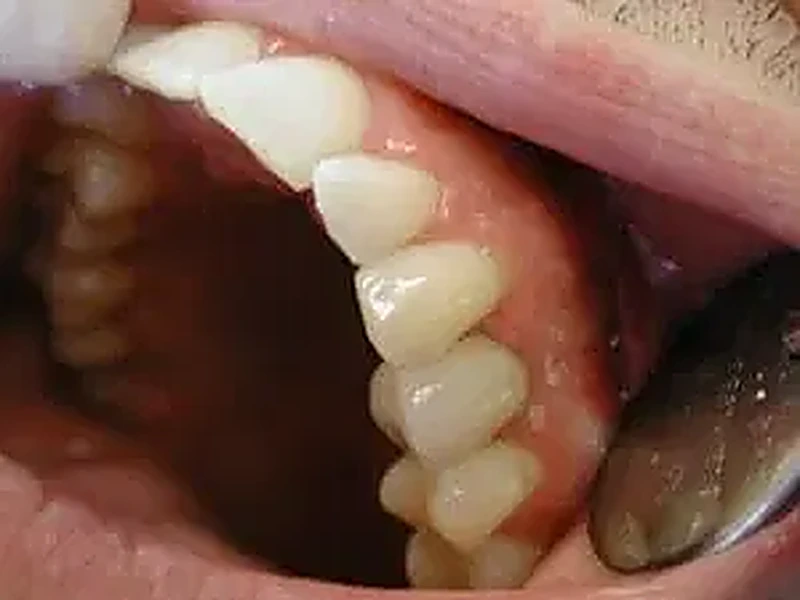 Implant dentaire après traitement — couronne sur implant unitaire, Bruxelles