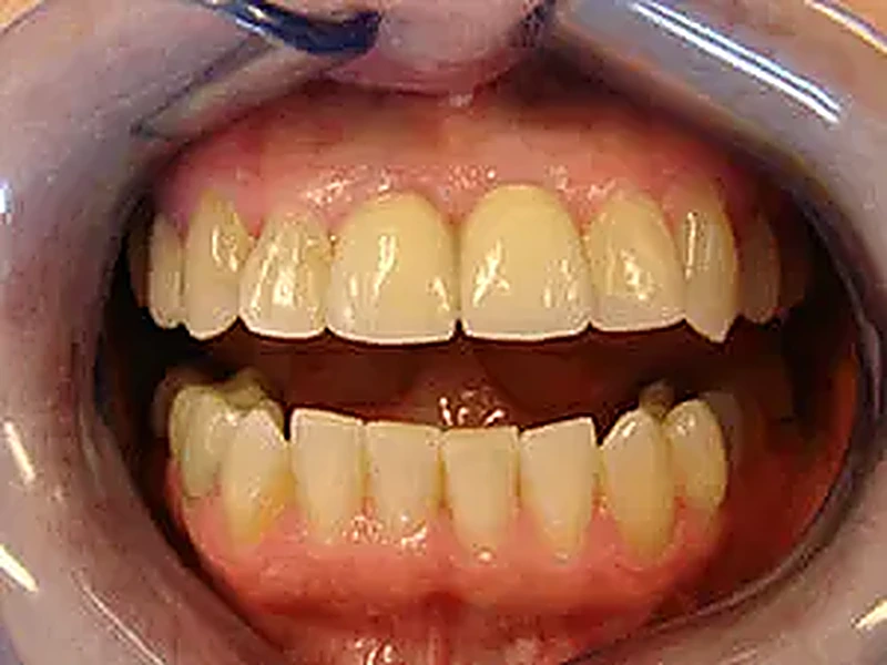 Implant dentaire après traitement — réhabilitation sur implants, Bruxelles
