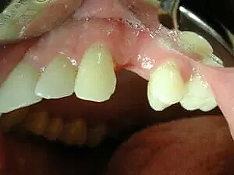 Implant dentaire avant traitement — couronne sur implant unitaire, Bruxelles